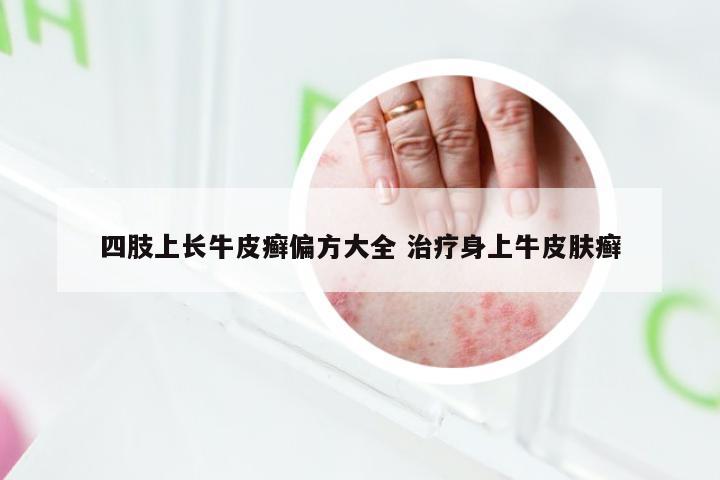 四肢上长牛皮癣偏方大全 治疗身上牛皮肤癣