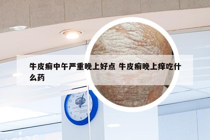 牛皮癣中午严重晚上好点 牛皮癣晚上痒吃什么药