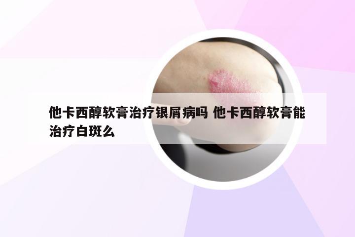他卡西醇软膏治疗银屑病吗 他卡西醇软膏能治疗白斑么