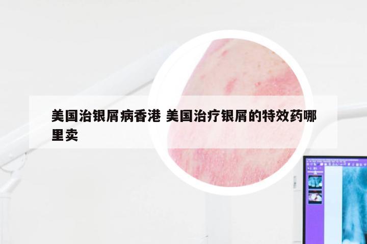 美国治银屑病香港 美国治疗银屑的特效药哪里卖