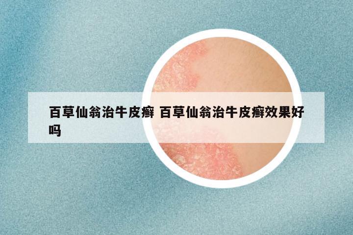 百草仙翁治牛皮癣 百草仙翁治牛皮癣效果好吗