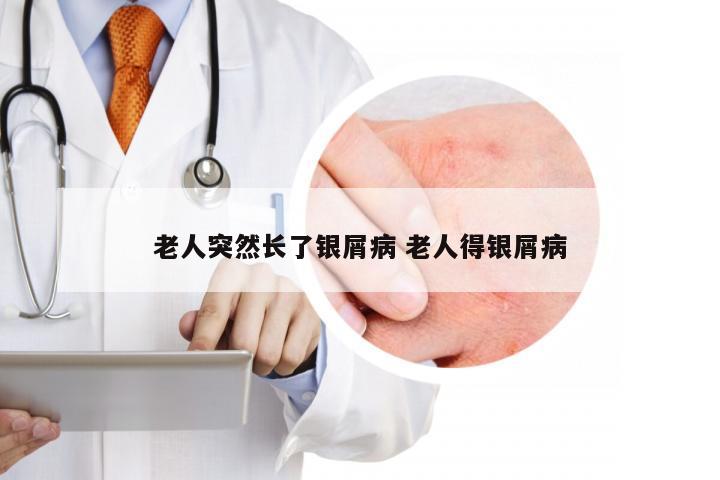 老人突然长了银屑病 老人得银屑病