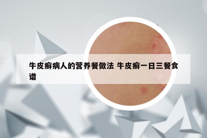 牛皮癣病人的营养餐做法 牛皮癣一日三餐食谱