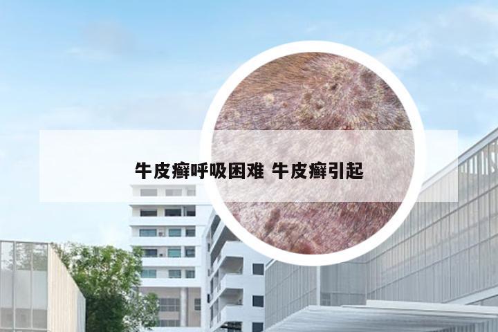 牛皮癣呼吸困难 牛皮癣引起