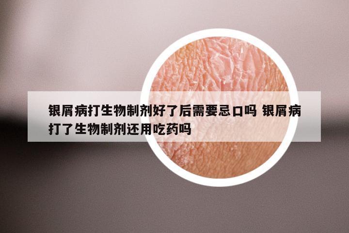 银屑病打生物制剂好了后需要忌口吗 银屑病打了生物制剂还用吃药吗