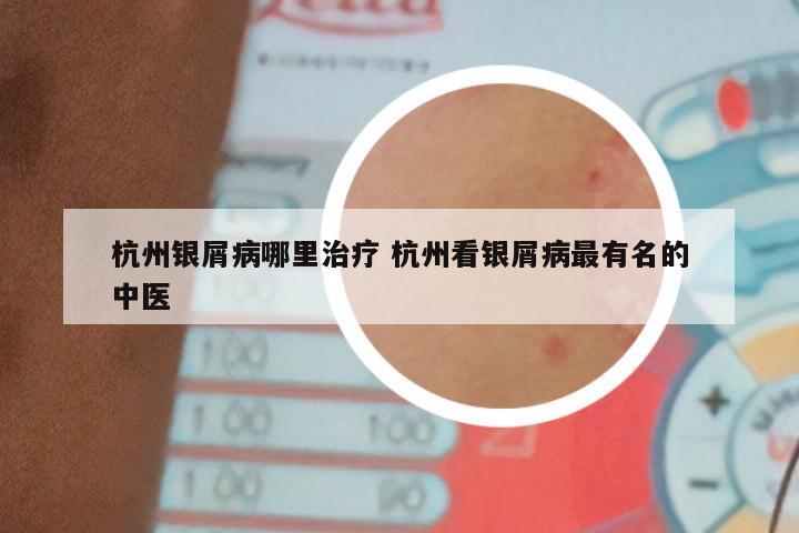 杭州银屑病哪里治疗 杭州看银屑病最有名的中医