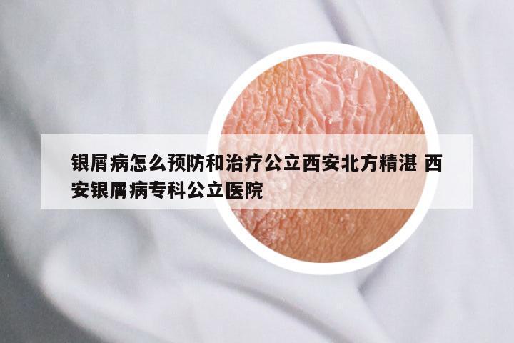 银屑病怎么预防和治疗公立西安北方精湛 西安银屑病专科公立医院