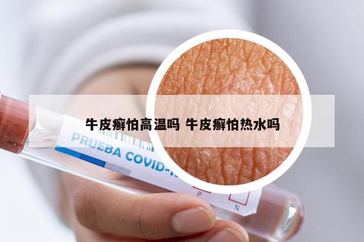 牛皮癣怕高温吗 牛皮癣怕热水吗