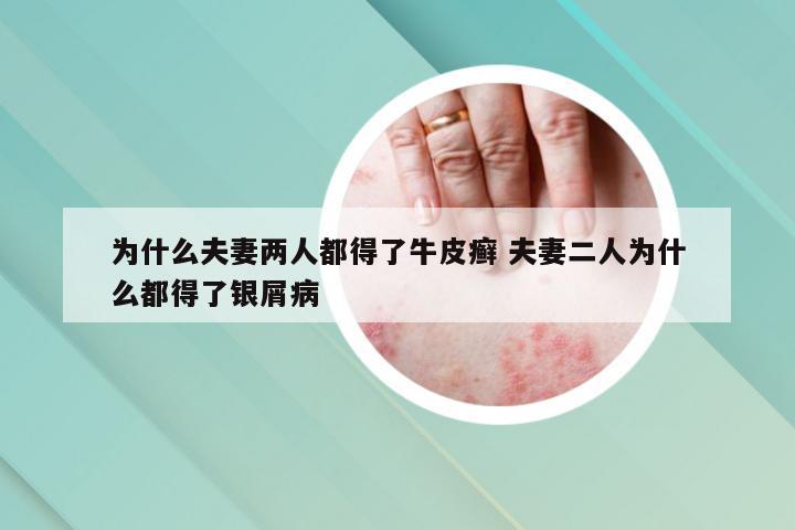 为什么夫妻两人都得了牛皮癣 夫妻二人为什么都得了银屑病