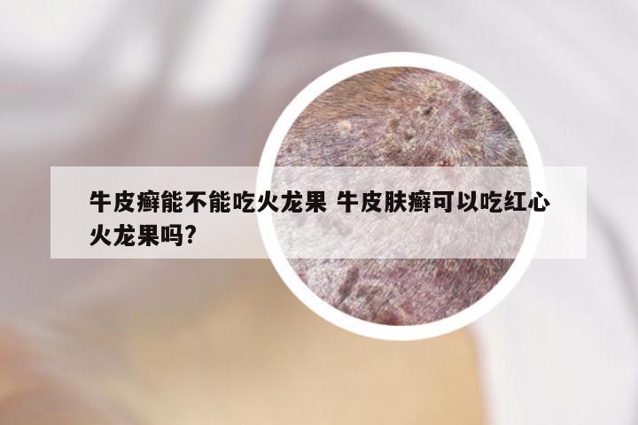 牛皮癣能不能吃火龙果 牛皮肤癣可以吃红心火龙果吗?