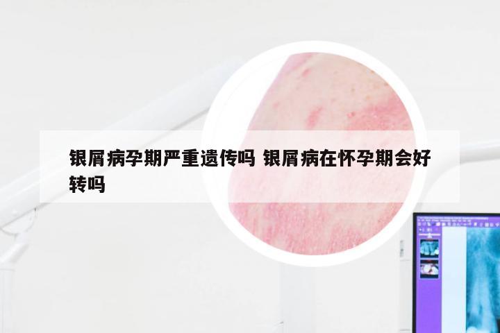 银屑病孕期严重遗传吗 银屑病在怀孕期会好转吗