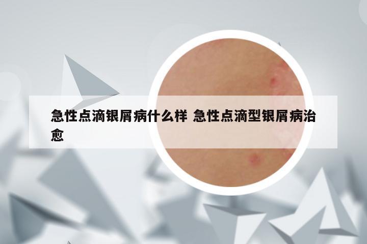 急性点滴银屑病什么样 急性点滴型银屑病治愈