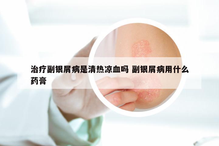 治疗副银屑病是清热凉血吗 副银屑病用什么药膏