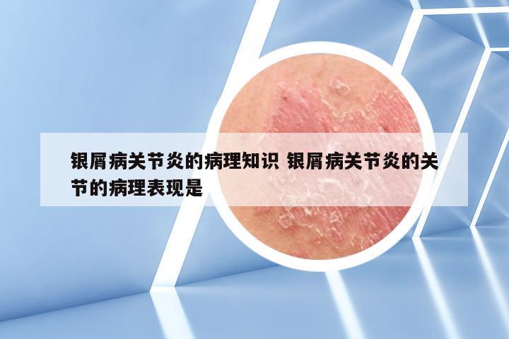 银屑病关节炎的病理知识 银屑病关节炎的关节的病理表现是