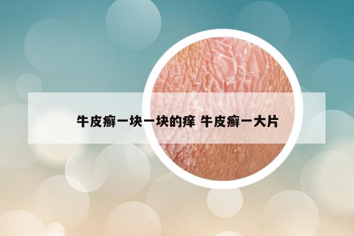 牛皮癣一块一块的痒 牛皮癣一大片