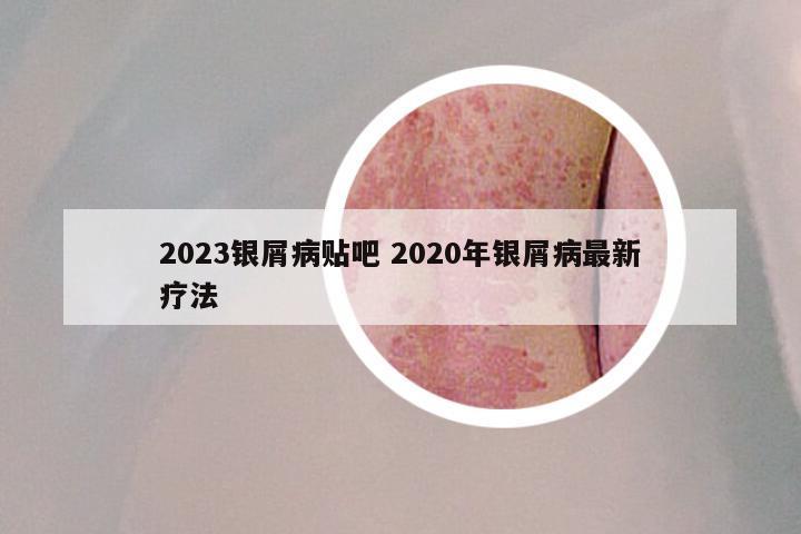 2023银屑病贴吧 2020年银屑病最新疗法