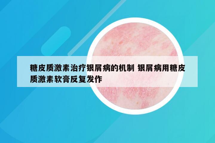 糖皮质激素治疗银屑病的机制 银屑病用糖皮质激素软膏反复发作