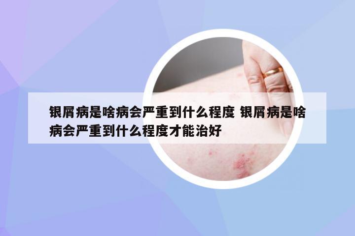 银屑病是啥病会严重到什么程度 银屑病是啥病会严重到什么程度才能治好