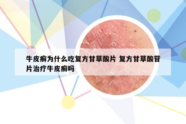 牛皮癣为什么吃复方甘草酸片 复方甘草酸苷片治疗牛皮癣吗
