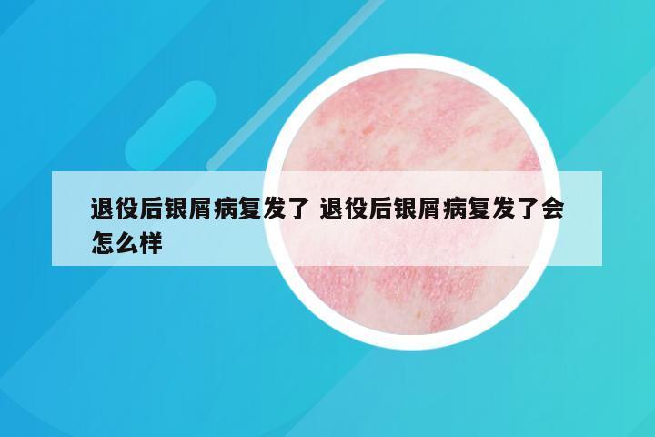 退役后银屑病复发了 退役后银屑病复发了会怎么样