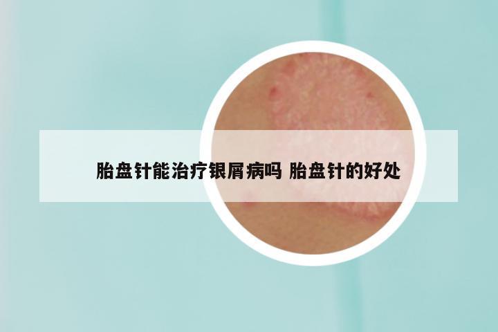 胎盘针能治疗银屑病吗 胎盘针的好处