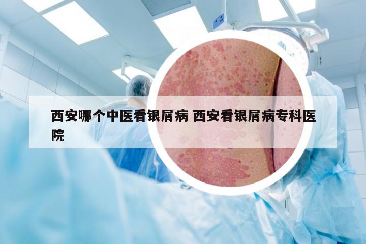 西安哪个中医看银屑病 西安看银屑病专科医院