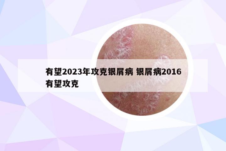 有望2023年攻克银屑病 银屑病2016有望攻克