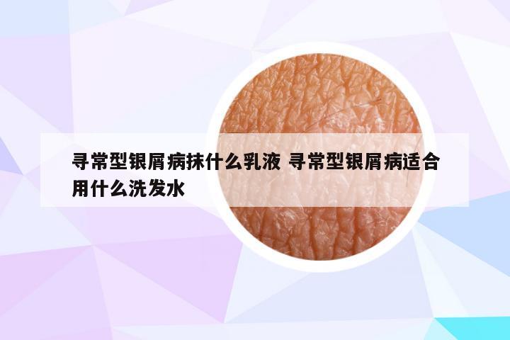 寻常型银屑病抹什么乳液 寻常型银屑病适合用什么洗发水