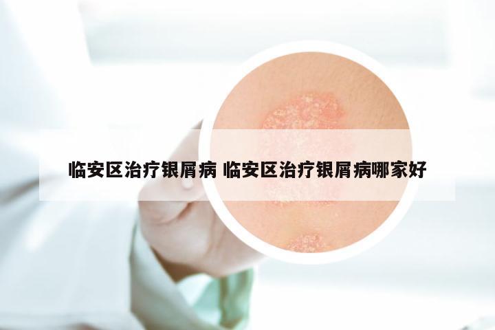 临安区治疗银屑病 临安区治疗银屑病哪家好