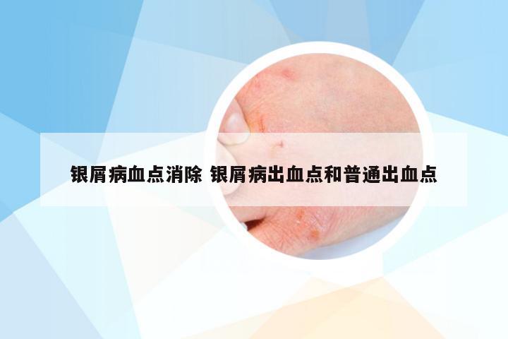 银屑病血点消除 银屑病出血点和普通出血点
