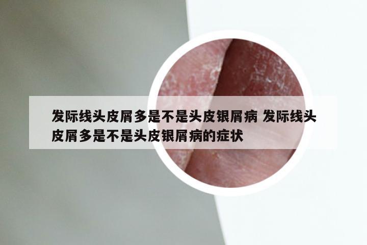 发际线头皮屑多是不是头皮银屑病 发际线头皮屑多是不是头皮银屑病的症状