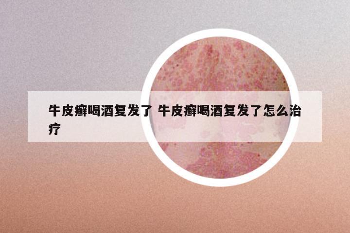 牛皮癣喝酒复发了 牛皮癣喝酒复发了怎么治疗