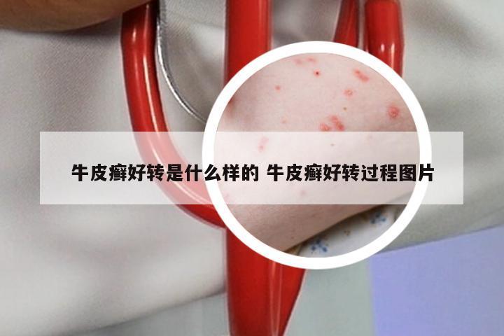 牛皮癣好转是什么样的 牛皮癣好转过程图片
