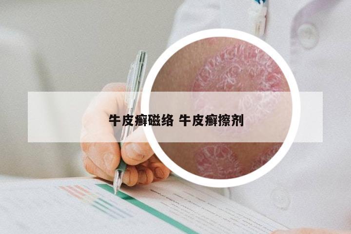 牛皮癣磁络 牛皮癣擦剂