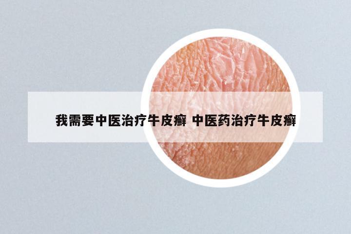 我需要中医治疗牛皮癣 中医药治疗牛皮癣