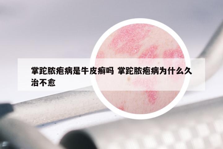 掌跎脓疱病是牛皮癣吗 掌跎脓疱病为什么久治不愈