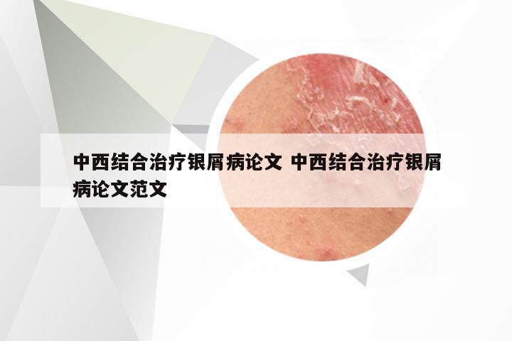中西结合治疗银屑病论文 中西结合治疗银屑病论文范文