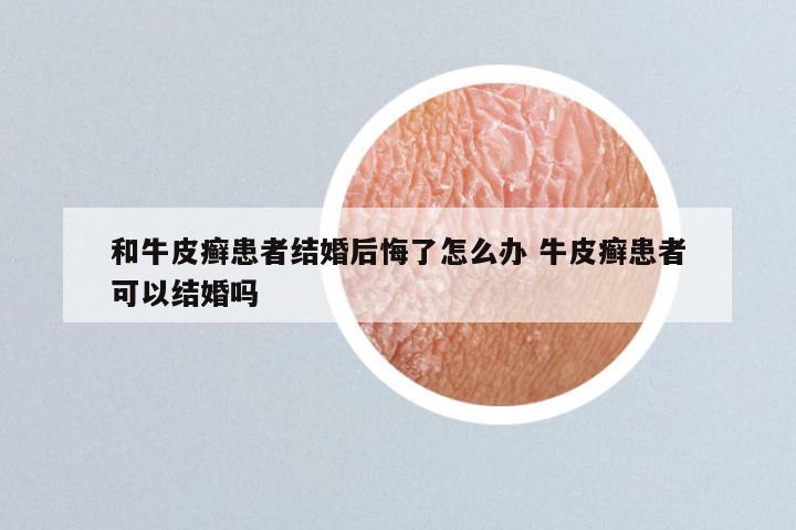 和牛皮癣患者结婚后悔了怎么办 牛皮癣患者可以结婚吗