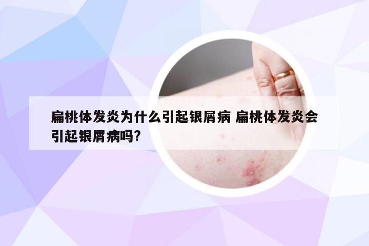 扁桃体发炎为什么引起银屑病 扁桃体发炎会引起银屑病吗?
