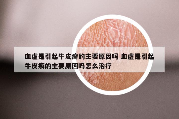 血虚是引起牛皮癣的主要原因吗 血虚是引起牛皮癣的主要原因吗怎么治疗