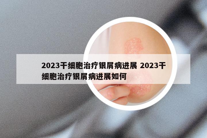 2023干细胞治疗银屑病进展 2023干细胞治疗银屑病进展如何