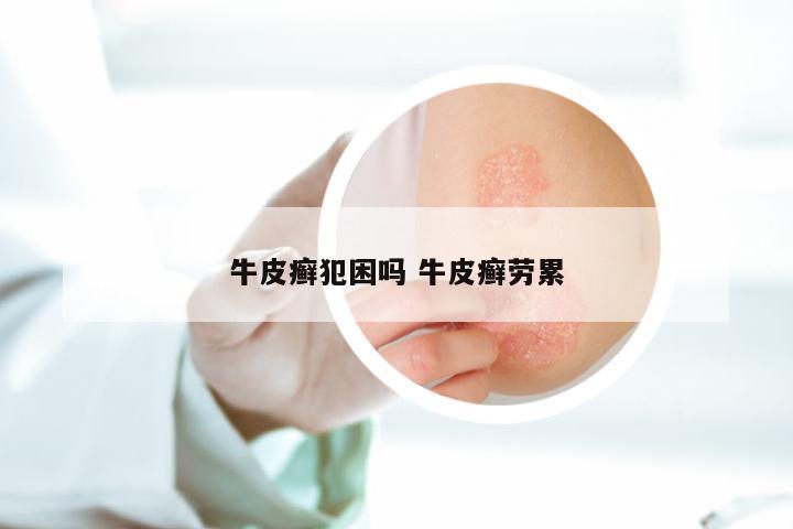 牛皮癣犯困吗 牛皮癣劳累