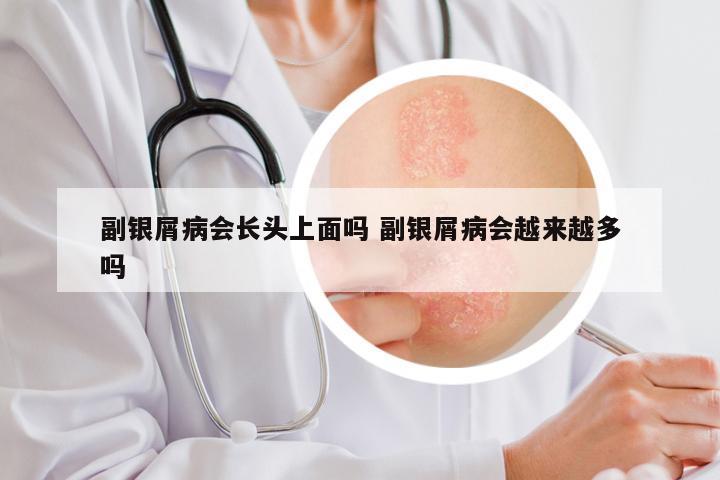副银屑病会长头上面吗 副银屑病会越来越多吗