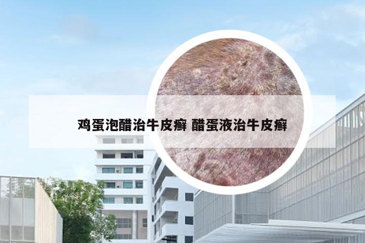鸡蛋泡醋治牛皮癣 醋蛋液治牛皮癣