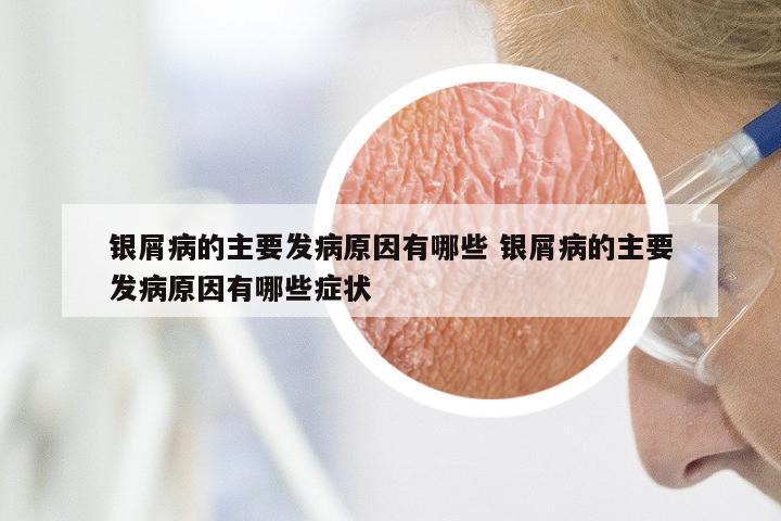 银屑病的主要发病原因有哪些 银屑病的主要发病原因有哪些症状