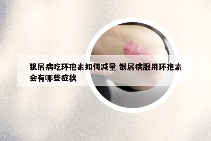 银屑病吃环孢素如何减量 银屑病服用环孢素会有哪些症状