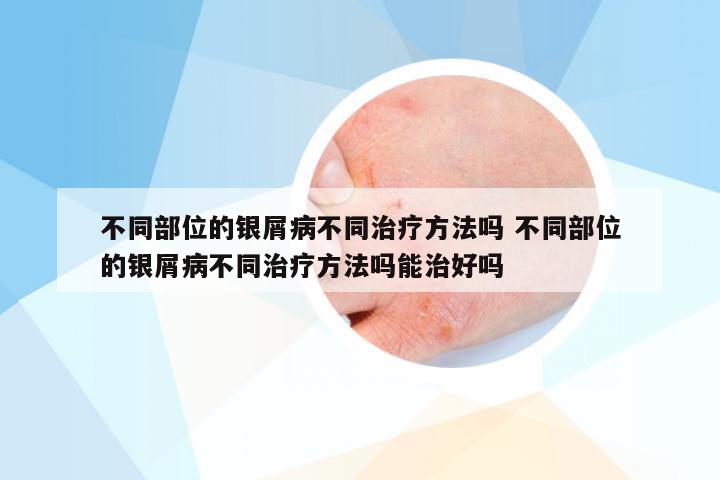 不同部位的银屑病不同治疗方法吗 不同部位的银屑病不同治疗方法吗能治好吗