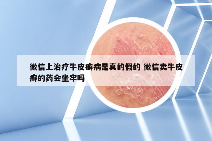 微信上治疗牛皮癣病是真的假的 微信卖牛皮癣的药会坐牢吗