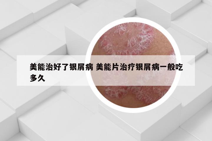 美能治好了银屑病 美能片治疗银屑病一般吃多久