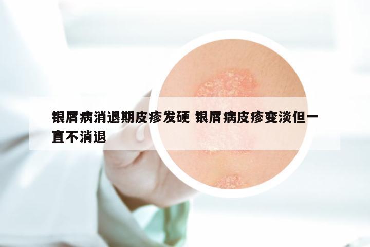 银屑病消退期皮疹发硬 银屑病皮疹变淡但一直不消退